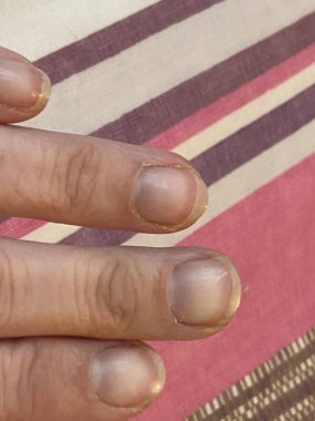 Çivilerdeki ay ışığı, kansızlık, yetersiz beslenme, böbrek hastalığı ya da başka bir şeyin belirtisidir. Sağlıksız proksimal kıvrımlı, tırnak içi 