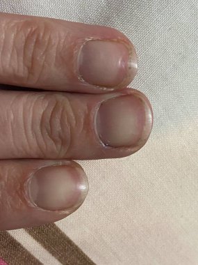Çivilerdeki ay ışığı, kansızlık, yetersiz beslenme, böbrek hastalığı ya da başka bir şeyin belirtisidir. Sağlıksız proksimal kıvrımlı, tırnak içi 