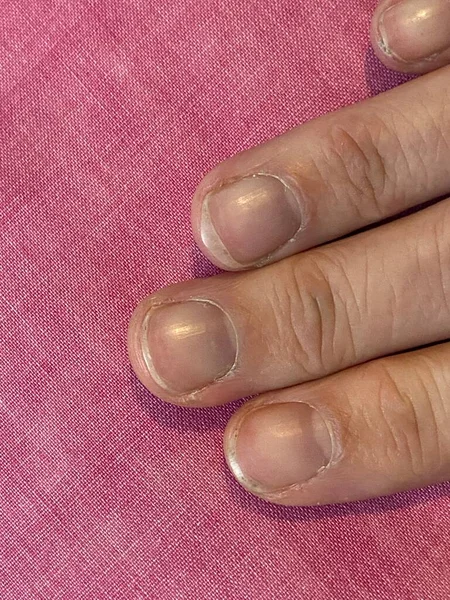 Unusual Shrunken Missing Lunula Half Moon Nails Which Symptom Anaemia — Stok fotoğraf