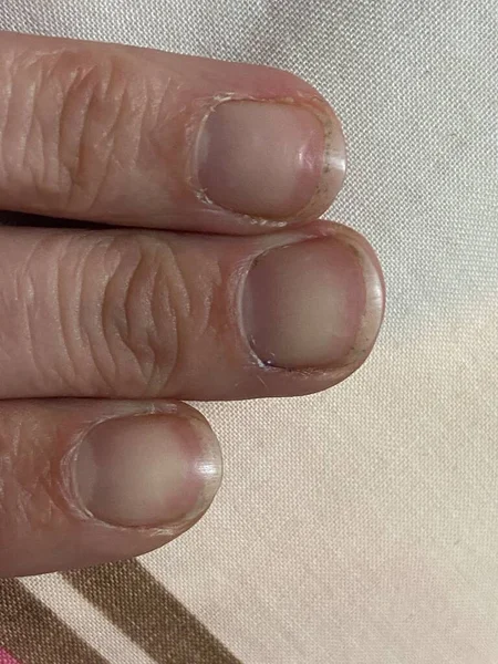 Çivilerdeki ay ışığı, kansızlık, yetersiz beslenme, böbrek hastalığı ya da başka bir şeyin belirtisidir. Sağlıksız proksimal kıvrımlı, tırnak içi 