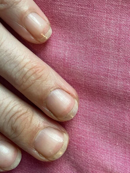 Terry's nails is leukonychia, characterized by opacification white most nail, missing lunula (half moon), and a narrow band of red of brown at tip can be anaemia, liver or kidney disease and others