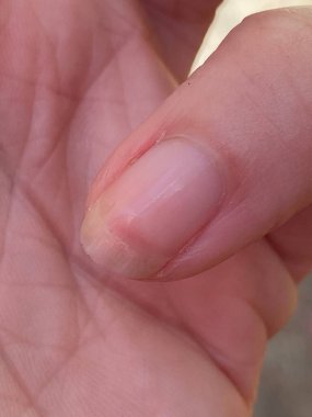 Terry 'nin tırnakları lökoniktir, opasifizasyon ile karakterize edilen çoğu tırnak, kayıp lunula (yarım ay), ve ucu kahverengi dar bir şerit anemi, karaciğer veya böbrek hastalığı ve diğerleri olabilir.