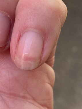 Terry 'nin tırnakları lökoniktir, opasifizasyon ile karakterize edilen çoğu tırnak, kayıp lunula (yarım ay), ve ucu kahverengi dar bir şerit anemi, karaciğer veya böbrek hastalığı ve diğerleri olabilir.