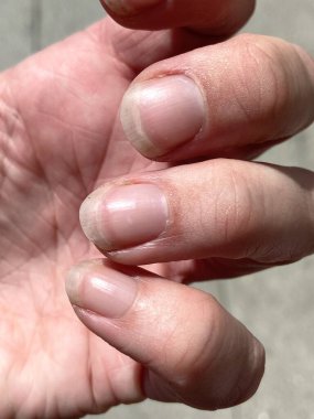 Terry's nails is leukonychia, characterized by opacification white most nail, missing lunula (half moon), and a narrow band of red of brown at tip can be anaemia, liver or kidney disease and others clipart