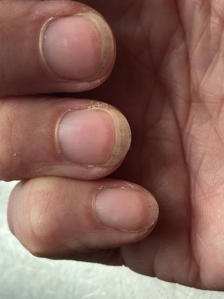 Νύχια Του Terry Είναι Leukonychia Χαρακτηρίζεται Από Αδιαφάνεια Λευκό Πλέον — Φωτογραφία Αρχείου
