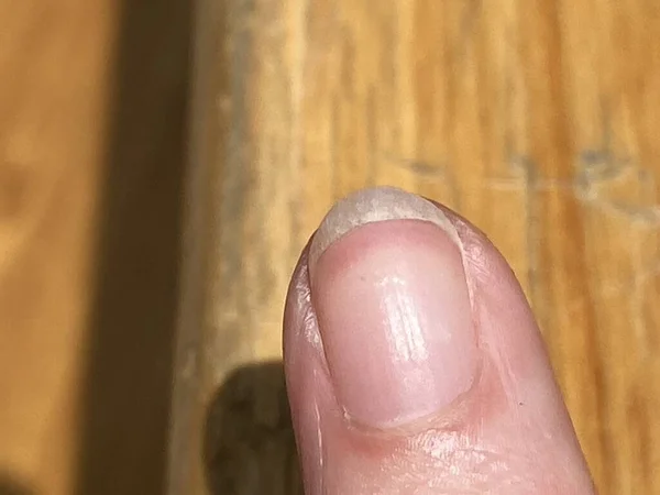 特里的指甲是白血病 其特征是最白的指甲泛滥成灾 漏掉了半月形的红斑 而最尖端的一条窄的红斑可能是贫血症 肝病或肾病等 — 图库照片
