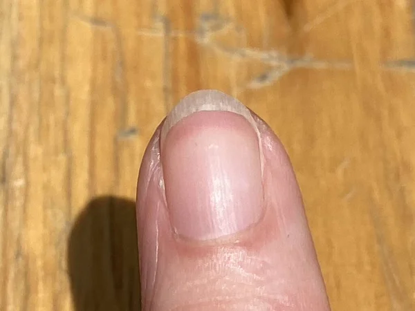 Terry's nails is leukonychia, characterized by opacification white most nail, missing lunula (half moon), and a narrow band of red of brown at tip can be anaemia, liver or kidney disease and others