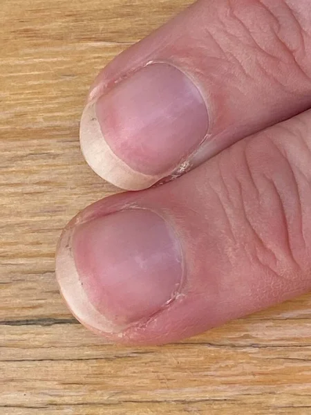 特里的指甲是白血病 其特征是最白的指甲泛滥成灾 漏掉了半月形的红斑 而最尖端的一条窄的红斑可能是贫血症 肝病或肾病等 — 图库照片
