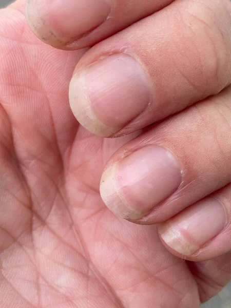 테리의 손톱은 대부분의 누룰라 사라진 것으로 특징을 이루는 백색증이며 갈색의 — 스톡 사진