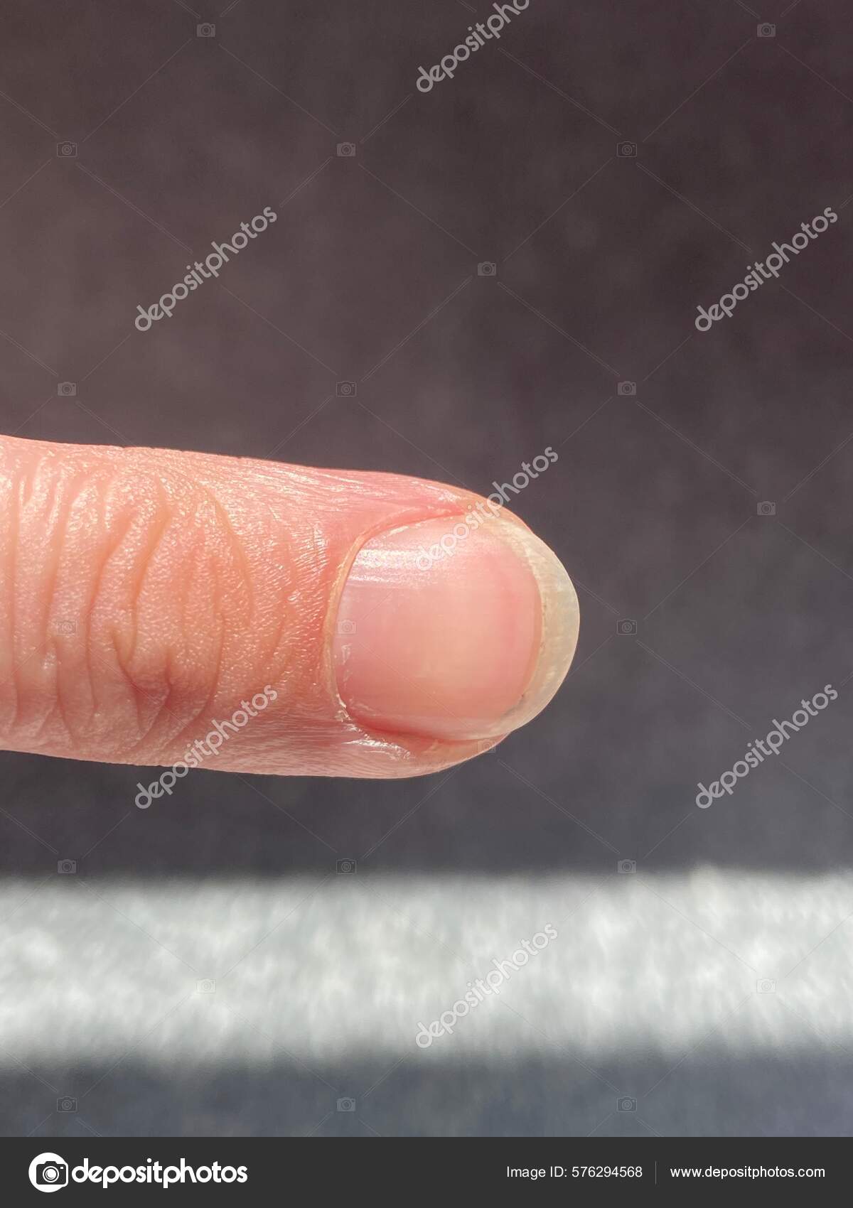 Terry S Nails Leukonychia Characterized Opacification White Most Nail Missing Lunula Stock Photo By C Cheekylorns2