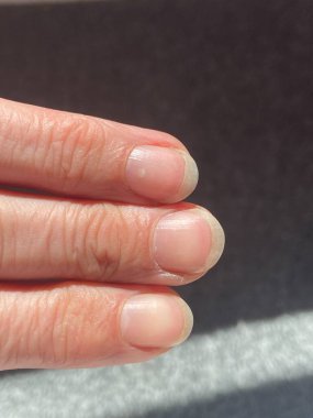 Terry 'nin tırnakları lökoniktir, opasifizasyon ile karakterize edilen çoğu tırnak, kayıp lunula (yarım ay), ve ucu kahverengi dar bir şerit anemi, karaciğer veya böbrek hastalığı ve diğerleri olabilir.