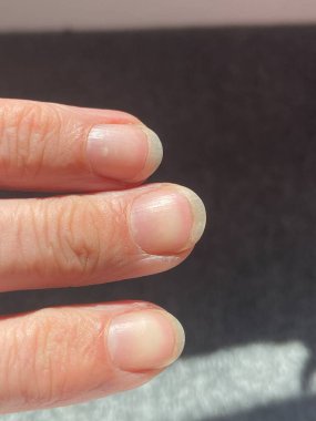 Terry 'nin tırnakları lökoniktir, opasifizasyon ile karakterize edilen çoğu tırnak, kayıp lunula (yarım ay), ve ucu kahverengi dar bir şerit anemi, karaciğer veya böbrek hastalığı ve diğerleri olabilir.