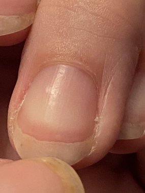 Terry 'nin tırnakları lökoniktir, opasifizasyon ile karakterize edilen çoğu tırnak, kayıp lunula (yarım ay), ve ucu kahverengi dar bir şerit anemi, karaciğer veya böbrek hastalığı ve diğerleri olabilir.