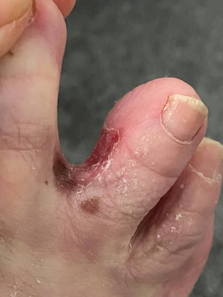 選手の足や足の指の間の虫 — ストック写真