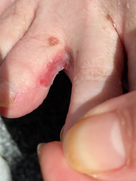 Athlete Foot Ringworm Toes — 스톡 사진