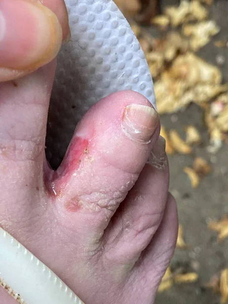 選手の足や足の指の間の虫 — ストック写真