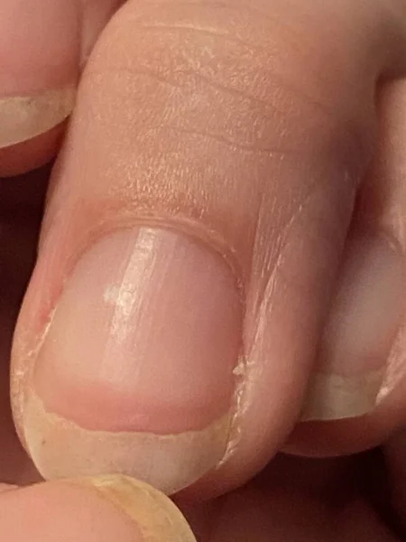 Νύχια Του Terry Είναι Leukonychia Χαρακτηρίζεται Από Αδιαφάνεια Λευκό Πλέον — Φωτογραφία Αρχείου