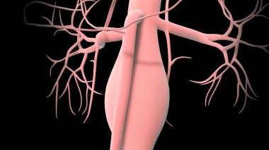 Abdominal aort anevrizması, vücudun ana atardamarının alt kısmının zayıflaması ve şişmesi sonucu oluşur.