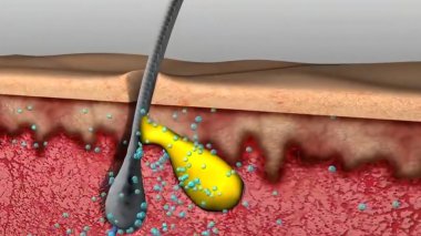 Sivilceler, Gelişim Aşamaları, Grafik Canlandırması