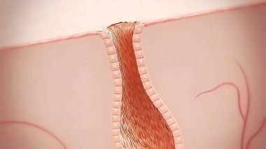 Sivilce ve Sivilceler, Gelişim Aşamaları, Grafiksel Çizimler