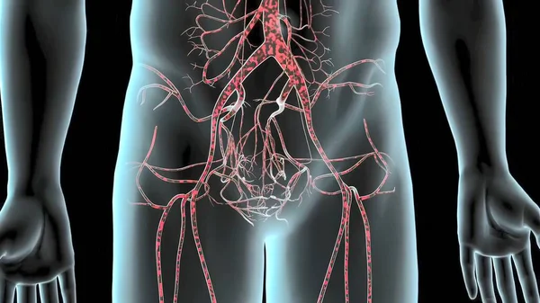 Abdominal Aort Anevrizması Vücudun Ana Atardamarının Alt Kısmının Zayıflaması Şişmesi — Stok fotoğraf