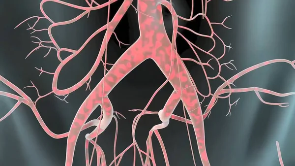 Aneurisma Aortico Addominale Verifica Quando Una Porzione Inferiore Dell Arteria — Foto Stock