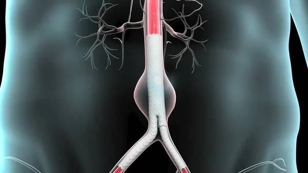 Abdominal Aort Anevrizması Vücudun Ana Atardamarının Alt Kısmının Zayıflaması Şişmesi — Stok fotoğraf