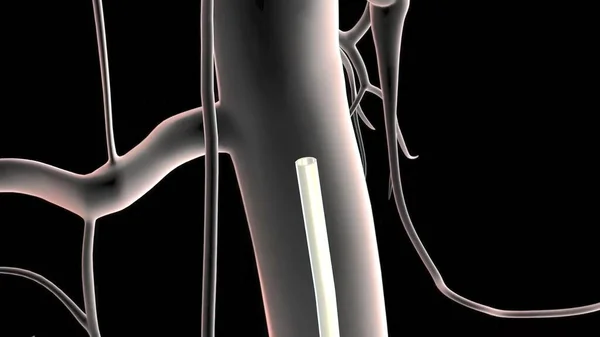 Abdominal Aortic Aneurysm Occurs Lower Portion Body Main Artery Aorta — Stock Photo, Image