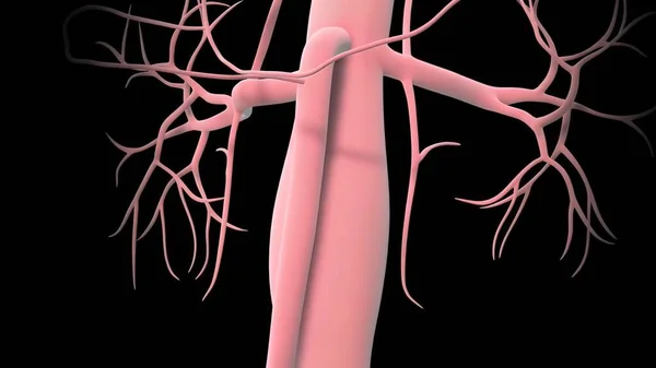 Aneurisma Aortico Addominale Verifica Quando Una Porzione Inferiore Dell Arteria — Foto Stock
