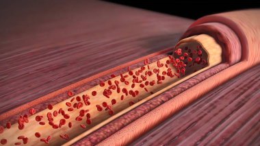 Kolesterol plağı, ateroskleroz ve kalp krizi.