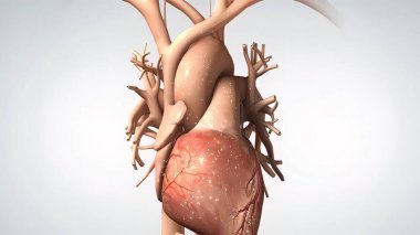 Akut Koroner Sendrom ve Kalp Krizi .