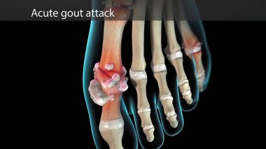 Gout is a form of arthritis. Sudden, severe attacks of pain, swelling clipart