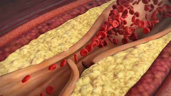 Kolesterol Plağı Ateroskleroz Kalp Krizi — Stok fotoğraf