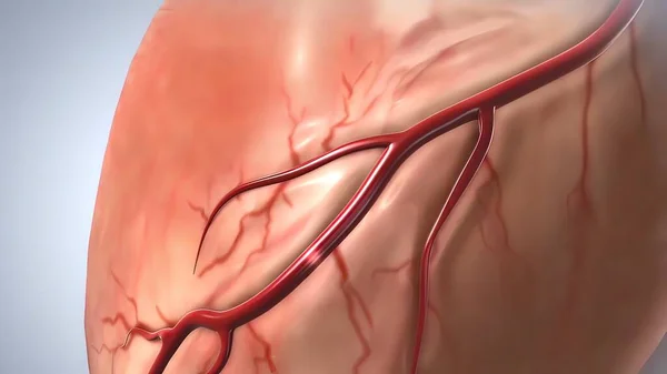 Sindrome Coronarica Acuta Infarto — Foto Stock