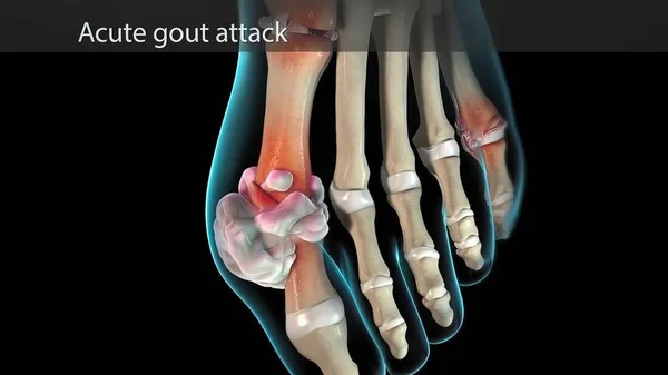 Gota Una Forma Artritis Ataques Repentinos Severos Dolor Hinchazón —  Fotos de Stock