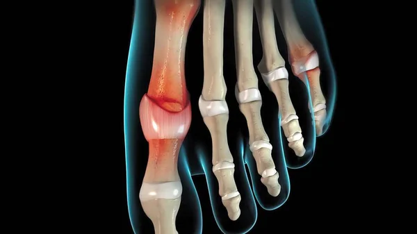 Gut Bir Tür Artrit Ani Şiddetli Ağrılar Şişkinlik — Stok fotoğraf