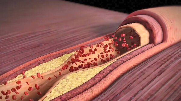 cholesterol plaque, atherosclerosis and heart attack