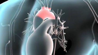 3 boyutlu pulsatil Abdominal Aort Anevrizması