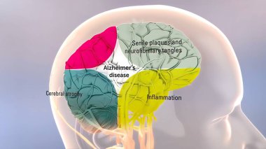 Amiloit Önleyici Protein İşlemi ve Alzheimer Hastalığı 3 boyutlu illüstrasyon