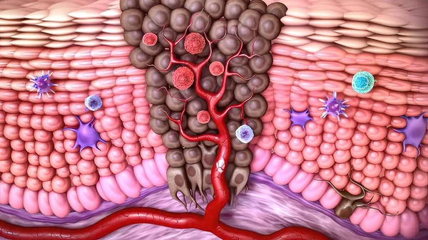 3d medical illustration of skin cancer: Squamous cell carcinoma, basal cell cancer