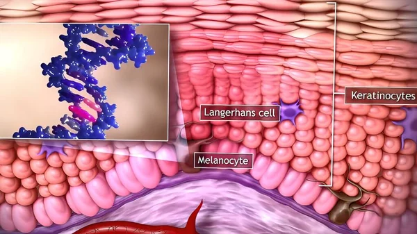 皮膚がんの3D医療イラスト 扁平上皮がん 基底細胞がん — ストック写真