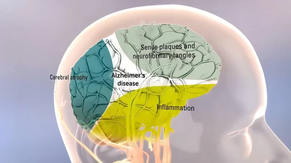 Precursore Dell Amiloide Trattamento Delle Proteine Malattia Alzheimer Illustrazione — Foto Stock