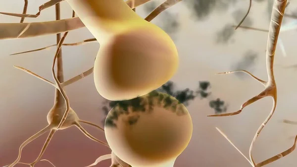 3D医療イラスト Amilod Plakes アルツハイマー病に関与する アミロイドタンパク質は 神経細胞間で凝集するいくつかの異なる分子の複合体である — ストック写真