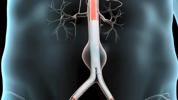 Medizinische Illustration Des Pulsatilen Abdominalen Aortenaneurysma — Stockfoto