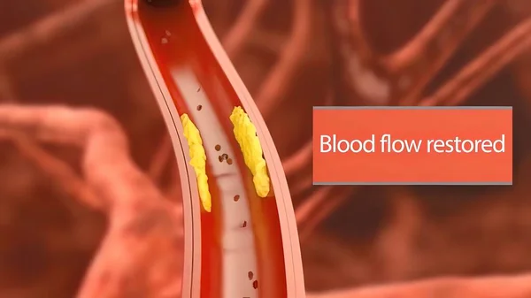 Aterosclerosi Accumulo Placche Ispessimento Delle Arterie Nel Rivestimento Interno Arteria — Foto Stock