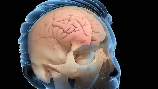 Medical Illustration Brain Injury — Stock Photo, Image