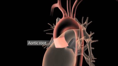 Hypoplastic left heart syndrome is a rare congenital heart defect in which the left side of the heart is severely underdeveloped.It may affect the left ventricle, aorta, aortic valve, or mitral valve. 3D Render clipart