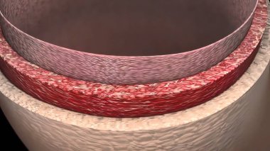 Aort anevrizması ve aort diseksiyonu 3D