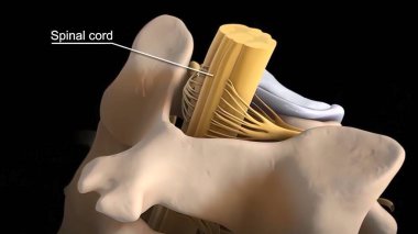 Kayan disk 3D oluşturma sonucu sinirlere baskı