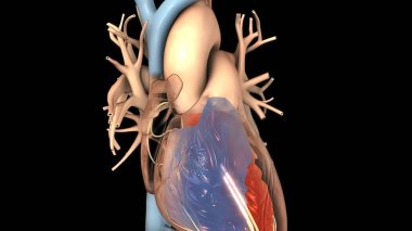 Kalp ritminin bozulması ve büyümesi 3D render